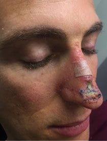 wound-healing-12days Bioptron Wound Healing 1